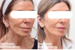 laser-resurfacing-skin-texture-rejuvenation-wrinkle-reduction