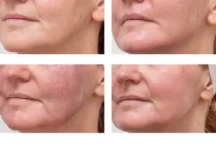 recovery-photos-following-non-ablative-laser-resurfacing