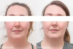 full-face-vascular-genesis