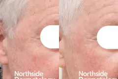photodynamic-therapy-sun-damage-solar-keratosis