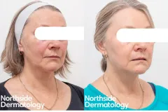1927nm-laser-resurfacing-sundamage-pigmentation