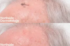age-spot-treatment-co2-laser