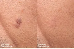 co2-laser-keratosis-pigment-laser