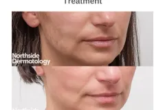 custom-peel-before-after