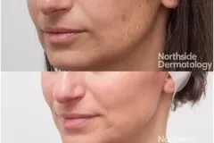 custom-peel-before-after2