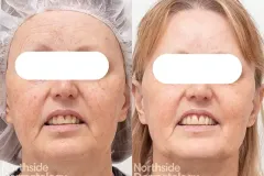 excel-v-laser-for-pigmentation2