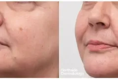 lasemd-1927nm-laser-resurfacing-results