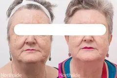 lasemd-ultra-1927nm-resurfacing-ba