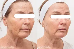 laser-resurfacing-prevention-ba