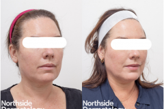 laser-resurfacing-thulium-laser-1927nm