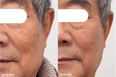 picosure-co2-combo-ba-F