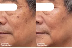 picosure-co2-combo-ba-L