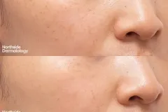 picosure-freckles-ba