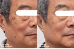 Picosure-Pro-and-co2-for-lentigines