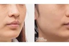 picosure-pro-freckle-2