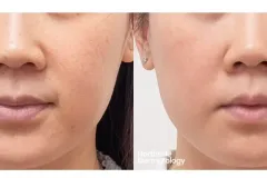 picosure-pro-rejuvenation-pigmentation-ba