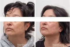 picosure-rejuvenation-pigmentation-ba