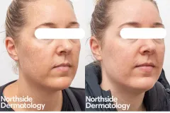 q-switched-pigment-removal