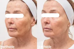 q-switched-toning-ba