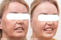 skin-rejuvenation-pigmentation-before and after