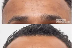 skin-rejuvenation-pigmentation-front-male