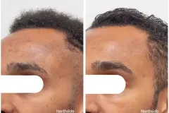 skin-rejuvenation-pigmentation-male