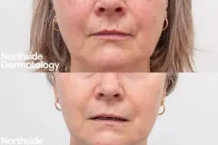 skin-resurfacing-pigmentation-texture-ba