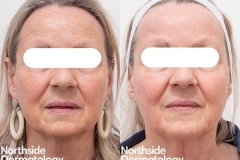 thulium-laser-skin-rejuvenation-4weeks2