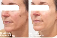 pigment-laser-q-switched-laser
