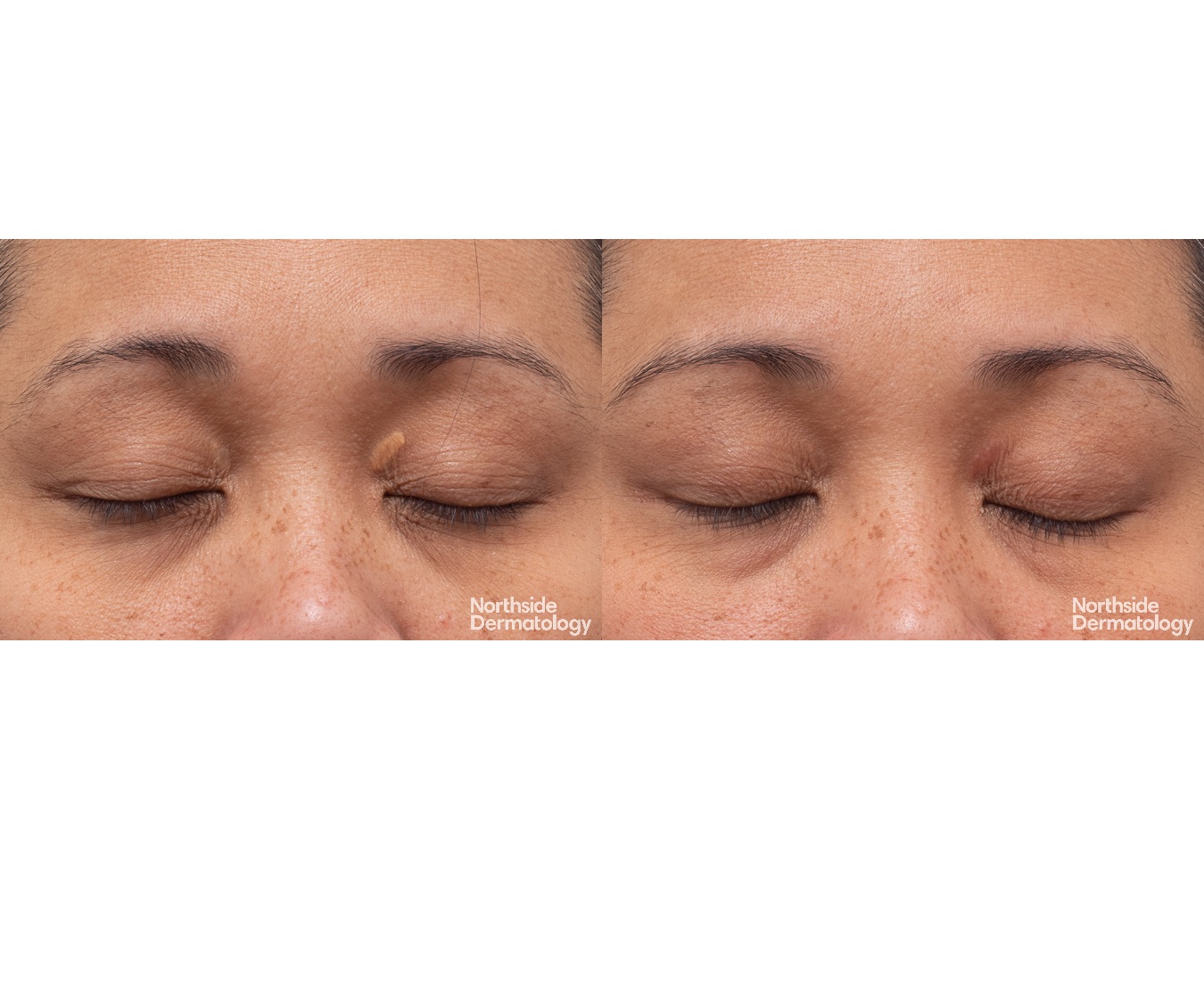 2473-YW-090581-CO2-XANTHELASMA-1-session