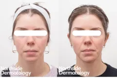 1_facial-contouring-injection-before-and-after