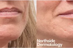 1_skin-rejuvenation-injection-before-and-after