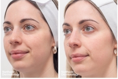 2468-AM-081191-CO2-COOL-PEEL-1-session-2-weeks-apart-b-and-a