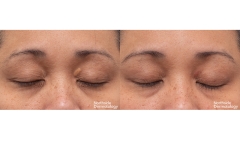 2473-YW-090581-CO2-XANTHELASMA-1-session