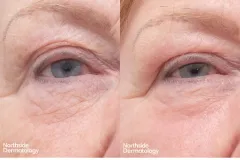CO2-eyelid-laser-rejuvenation-before-and-after