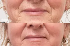 co2-injection-rejuvenation-before-and-after