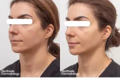 facial-contouring-injection-before-and-after