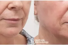 injection-laser-treatment-before-and-after2