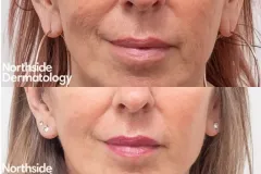 laseMD-rejuvenation-wrinkles-before-and-after