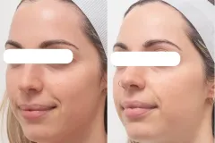 lasemd-rejuvenation-brightening