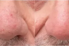 nose-rhinophyma-resurfacing-before-and-after
