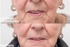 perioral-lines-injection-before-and-after