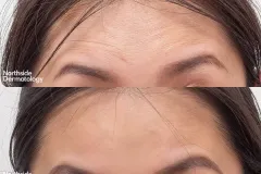 rejuran-rejuvenation-before-and-after