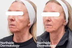 rejuvenation-anti-wrinkle-before-and-after