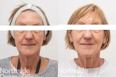 rejuvenation-injection-before-and-after