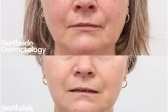 resurfacing-pigment-laser-before-and-after