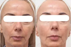 rf-resurfacing-rejuvenation-before-and-after