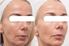 rf-resurfacing-rejuvenation-before-and-after2