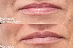 skin-rejuvenation-injectable-before-and-after