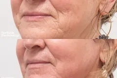 skin-rejuvenation-injection-before-and-after